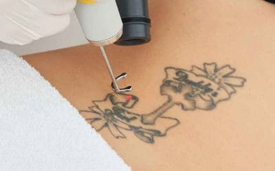 Rethink the Ink: Why More Melburnians are getting their Tattoos Removed
