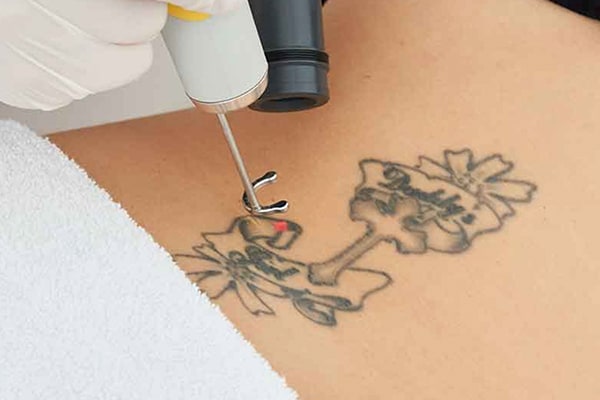 FAQ Tattoo removal