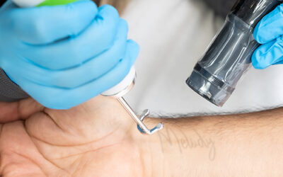 Why Laser Tattoo Removal is the Safest and Most Effective Method